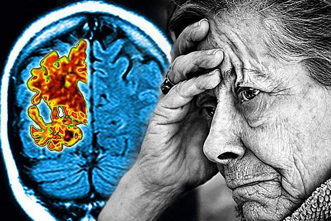 дегенеративные заболевания мозга болезнь Альцгеймера и Паркинсона