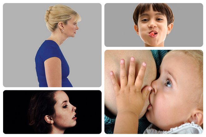 Кормление грудью помогает, потому что от ребенка требуется больше усилий, чем сосание бутылочки. Поощряйте своих детей жевать, даже жевательную резинку. Плохая осанка способствует сужению дыхательных путей. Дыхание через рот это показатель того, что вы не получаете достаточно кислорода.