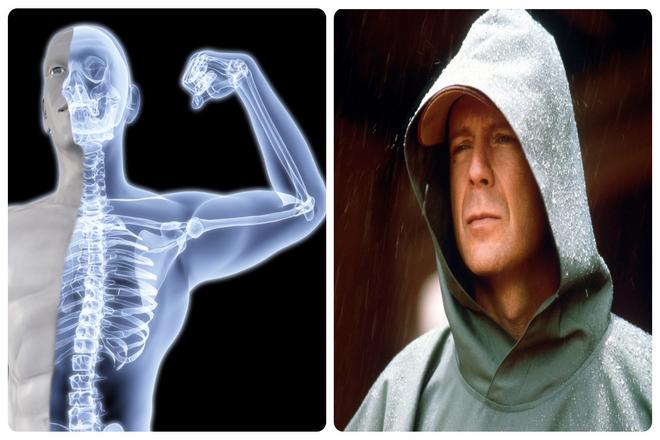 Плотные кости не являются чем-то необычным. Но плотные кости обычно становятся хрупкими и легко ломаются в состоянии, называемом остеопорозом. Интересно, что исследования выявили несколько уникальных людей, кости которых не только плотные, но и не ломаются.