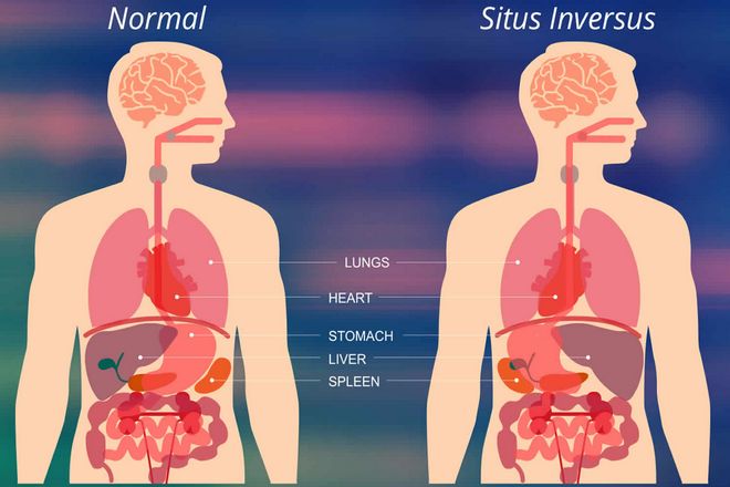 Проблема нарушения симметрии, это то, что называется situs inversus totalis. При котором органы развиваются в грудной и брюшной полости в идеальной зеркальной конфигурации. Но поскольку все правильно сформировано и расположено относительно всего остального, это не имеет большого значения.