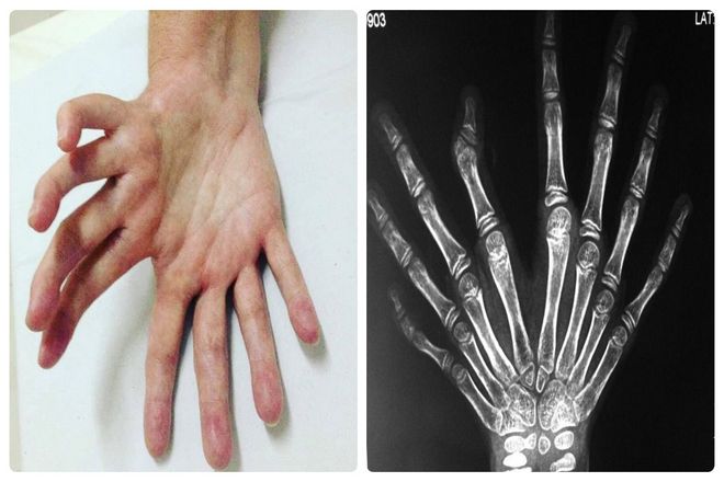 Исследователи все еще регулярно открывают новые факты о синдроме зеркальной руки. Заболевание не является наследственным и может быть вызвано генетической мутацией. К сожалению, это всего лишь гипотеза. Так как никто точно не знает, что вызывает это редкое заболевание.