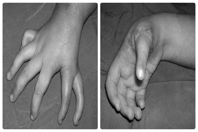 В то время как конечность с заболеванием может казаться сдвоенной посередине. Обычно это не включает большой палец. Вместо этого, пораженные руки, имеют два указательных пальца в центре или один общий указательный палец. В таких случаях в руке пострадавшего человека отсутствует кость большого пальца.