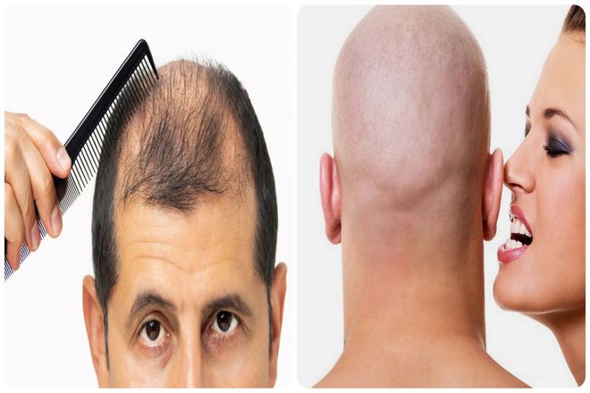 Наверняка, какими бы проблемами с волосами ни был обременен мужчина, он вряд ли будет рассматривать кастрацию как лечение.