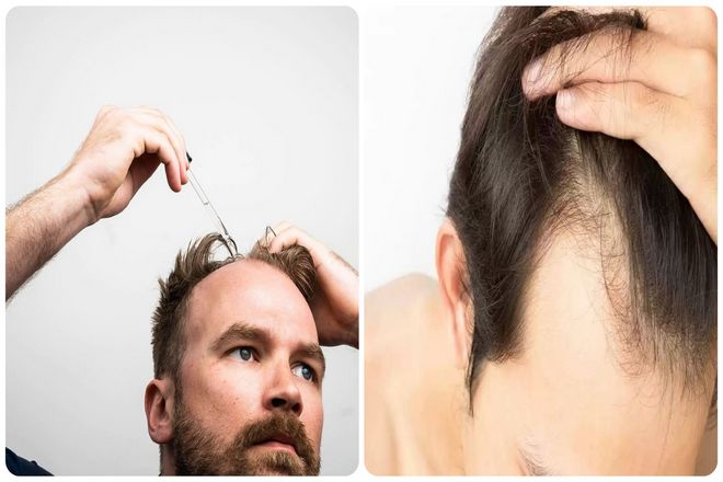 Оказывается, на самом деле именно продукт метаболизма тестостерона, известный как дигидротестостерон, вызывает выпадение волос. Это то же самое вещество, которое также вызывает увеличение простаты у мужчин.